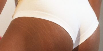 Close-up of stretch marks on skin